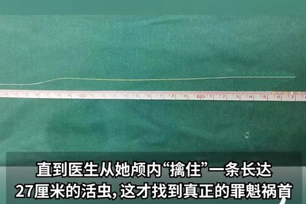 你還敢喝生水嗎？女子頭疼開刀竟取出27厘米活蟲！